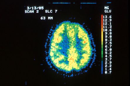 PET Scan of a Normal Brain